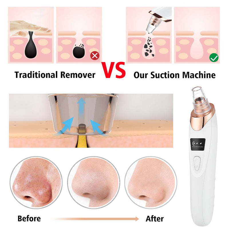 Blackhead Vacuum Remover